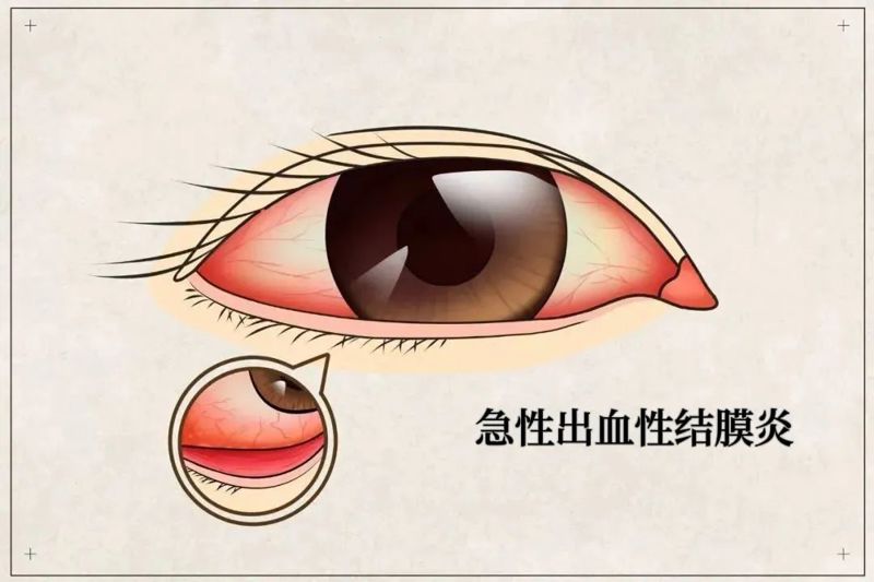 【健康科普】“红眼病”进入高发期，看一眼就传染吗？身边有人得了怎么办？